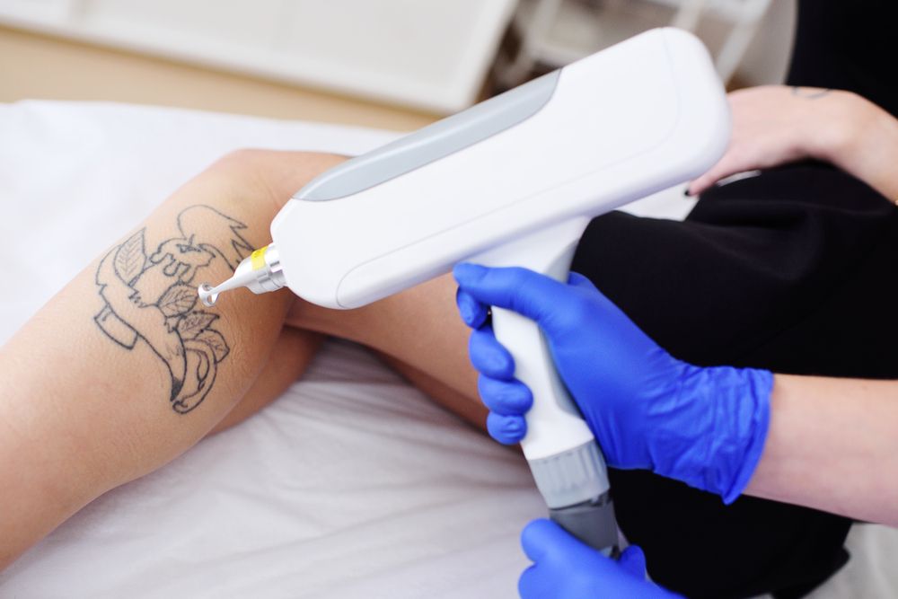 Breaking Barriers: Tattoo Removal and the Journey Back into Society