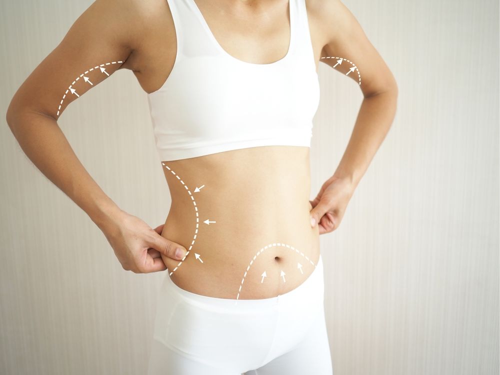 liposuction weight loss