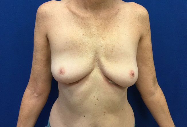 Breast Revision After