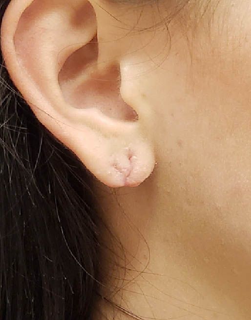 Torn Earlobe After