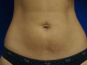 After Liposuction 