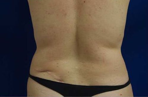 After Liposuction 