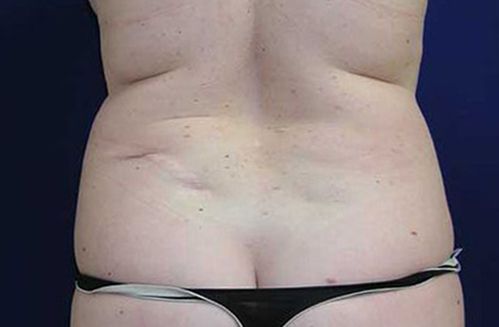 Before Liposuction 