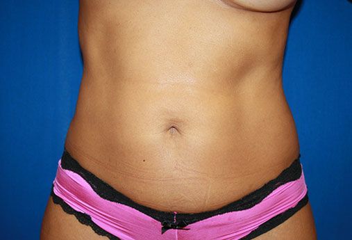 After Liposuction 