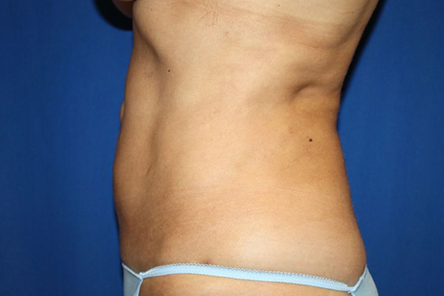 After Liposuction 