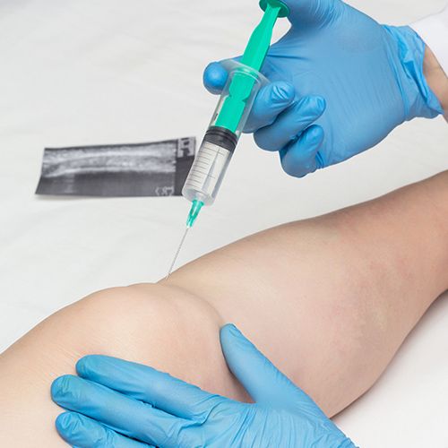 Viscosupplementation Knee Injections