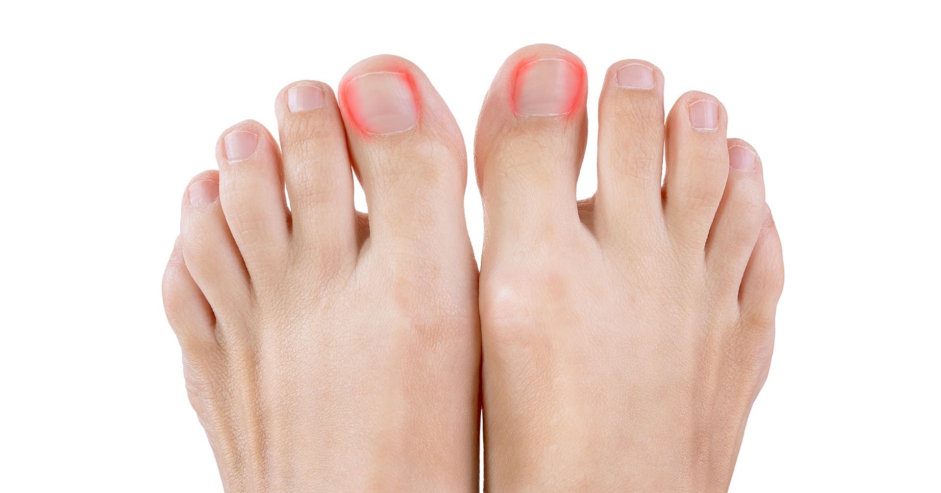 Get Relief from Ingrown nails now!