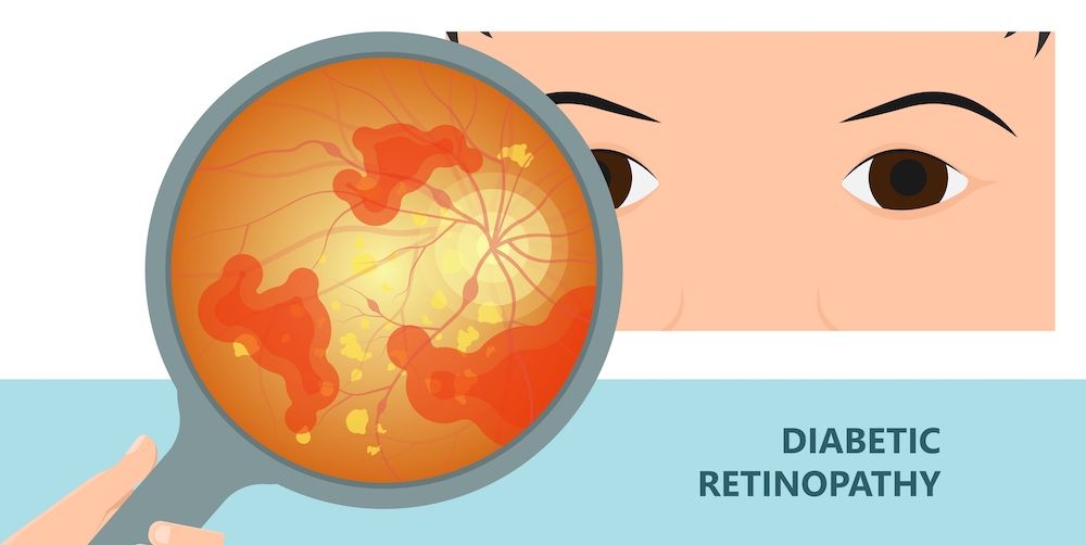 Symptoms of Diabetic Retinopathy