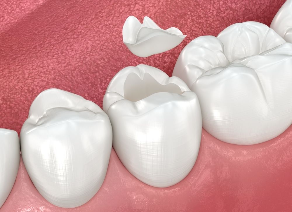 Restorative Dentistry: When One Filling Isn&rsquo;t Enough