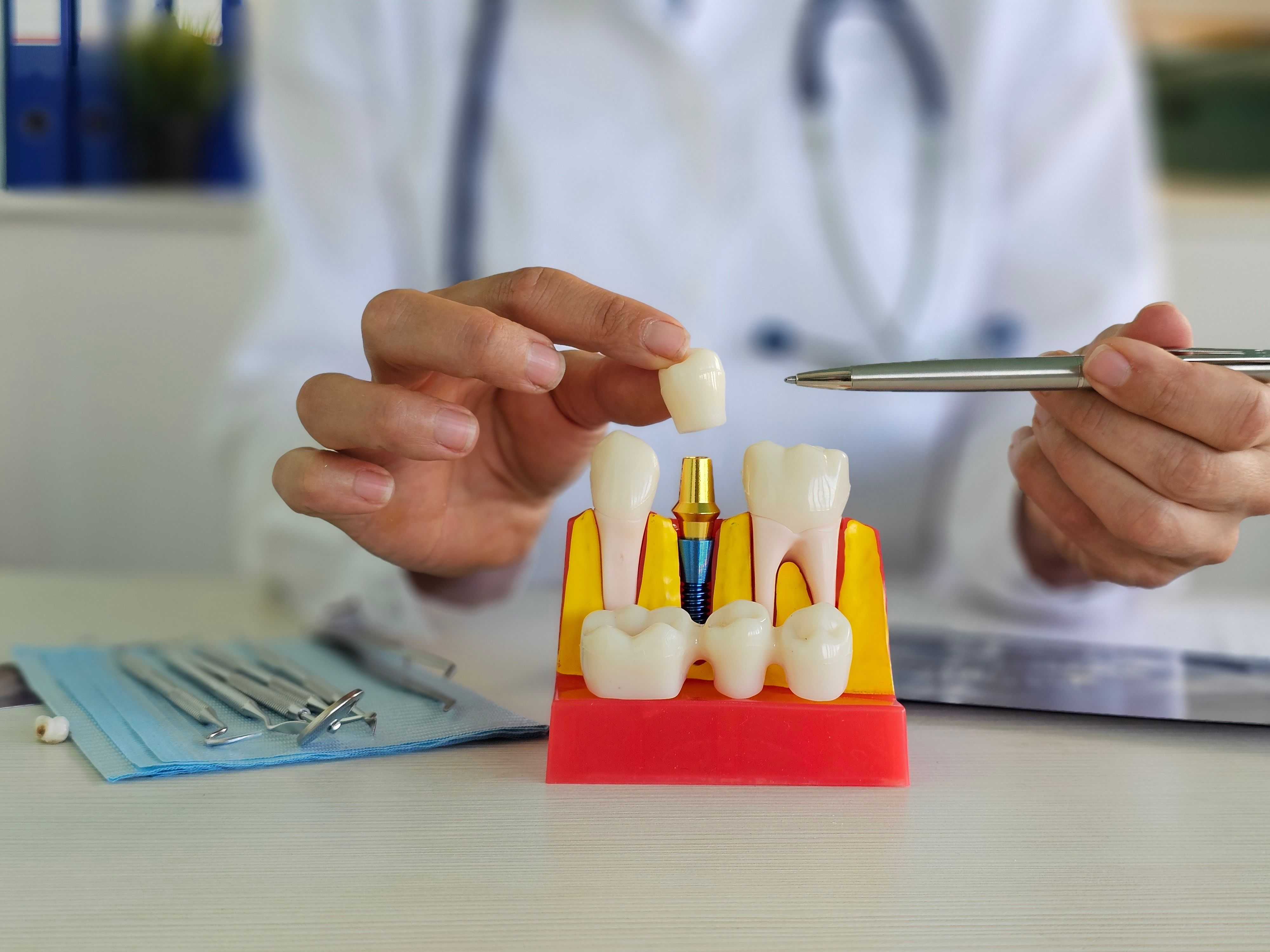 Dental Implant vs. Bridge: Which Should You Choose?