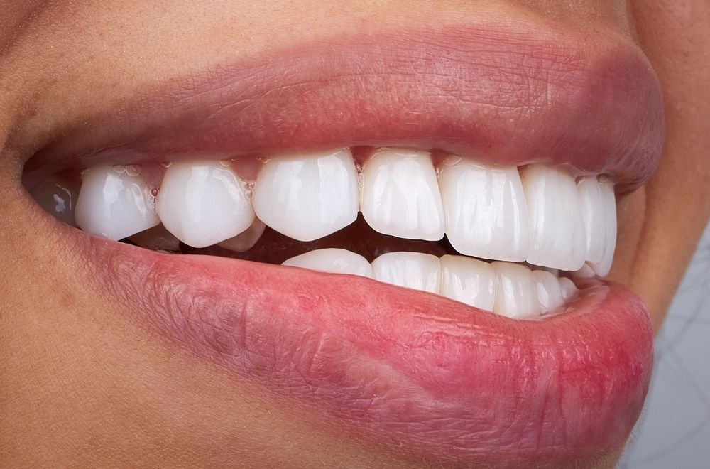 Top Benefits of In-Office Teeth Whitening Over Take-Home Kits