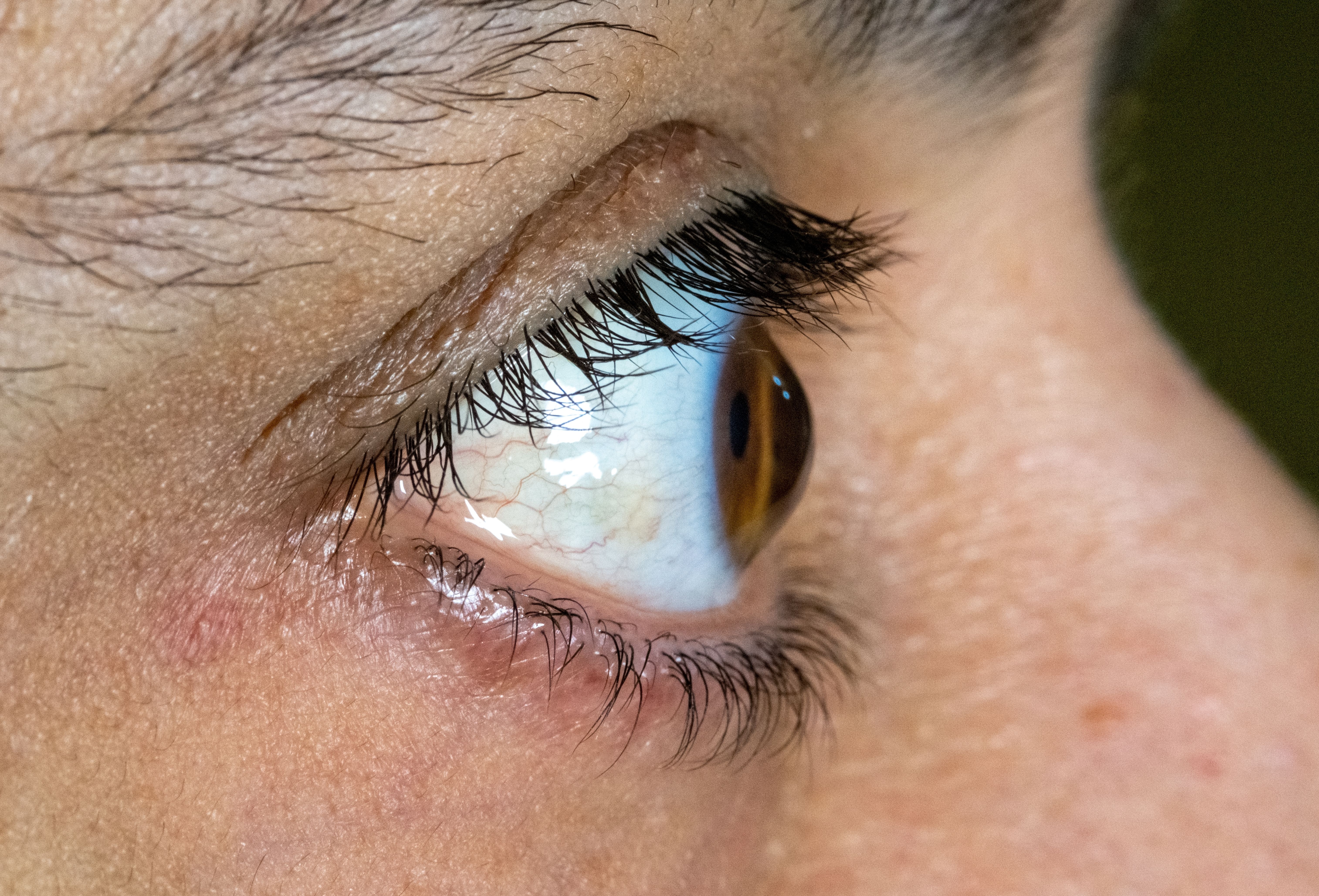 What Is the Main Cause of Keratoconus?