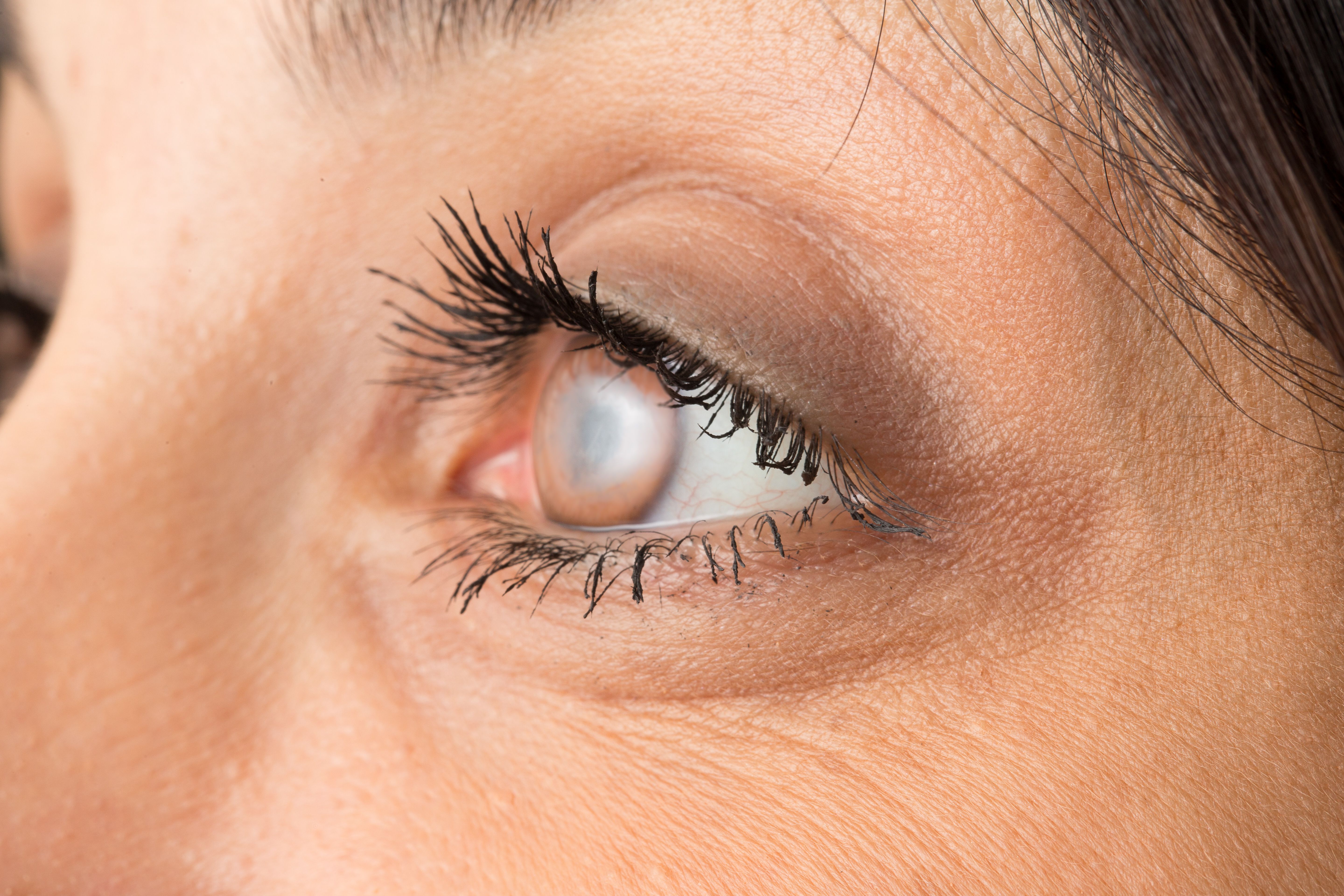 What to Expect Before, During, and After Cataract Surgery