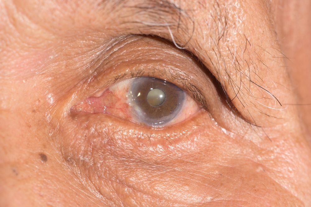 How Cataracts Develop - Myths vs. Facts