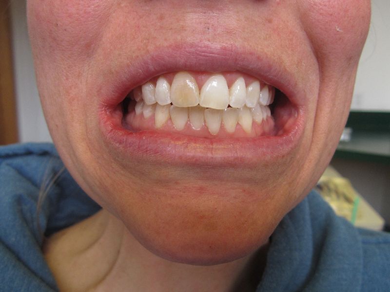 before female veneer procedure