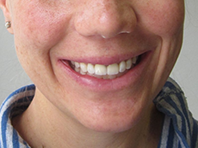 After female veneer procedure
