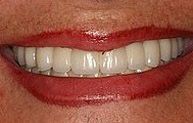 after procedure