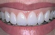 after porcelain crown