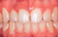After Dental Implant