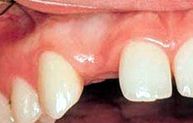 Before Dental Implant