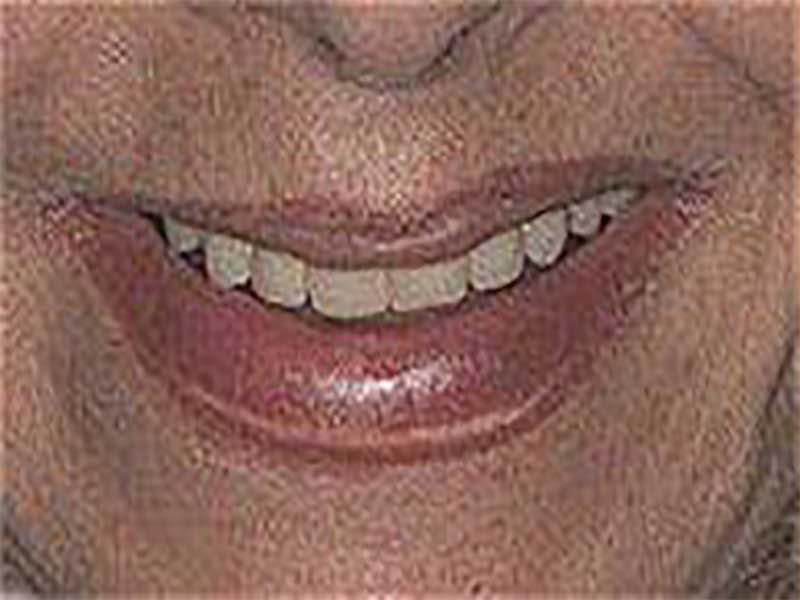 Before porcelain crown dental procedure