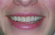 after veneer procedure
