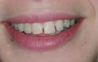 before veneer procedure
