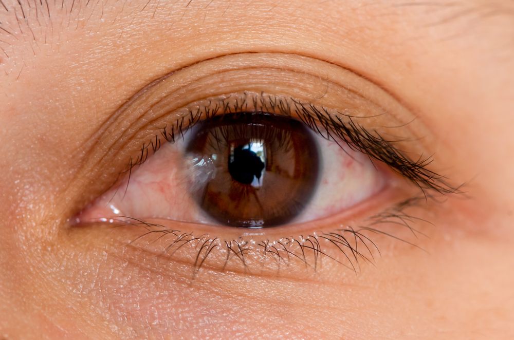 What Is the Main Cause of Pterygium?