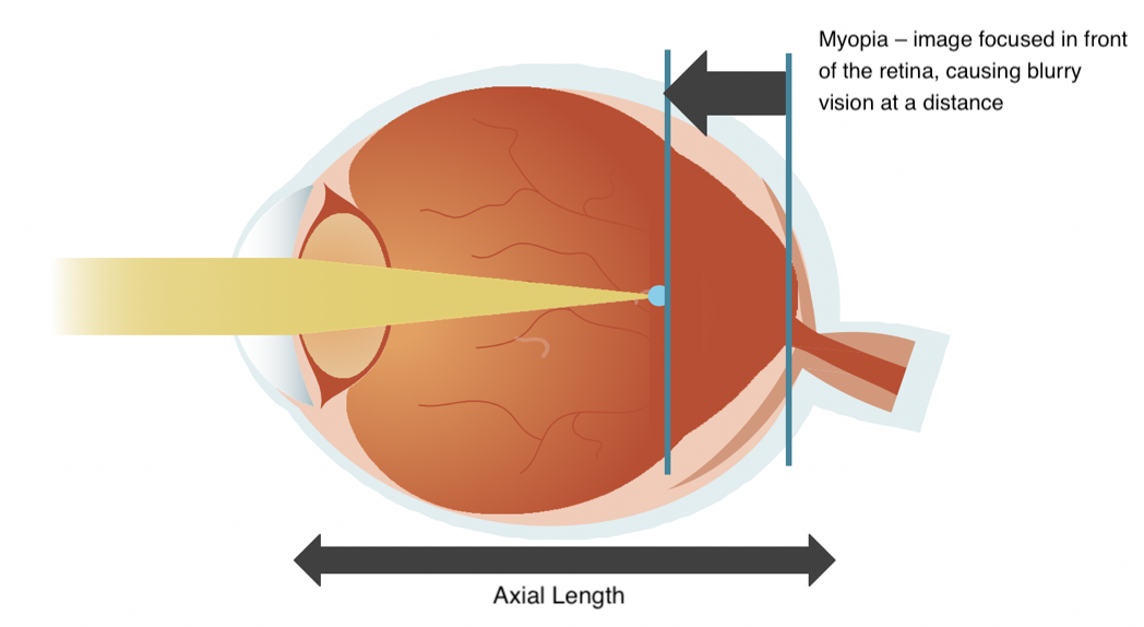 Visual of how light enters and effects a myopic eye