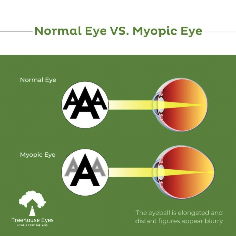 Normal Eye versus myopic eye visual
