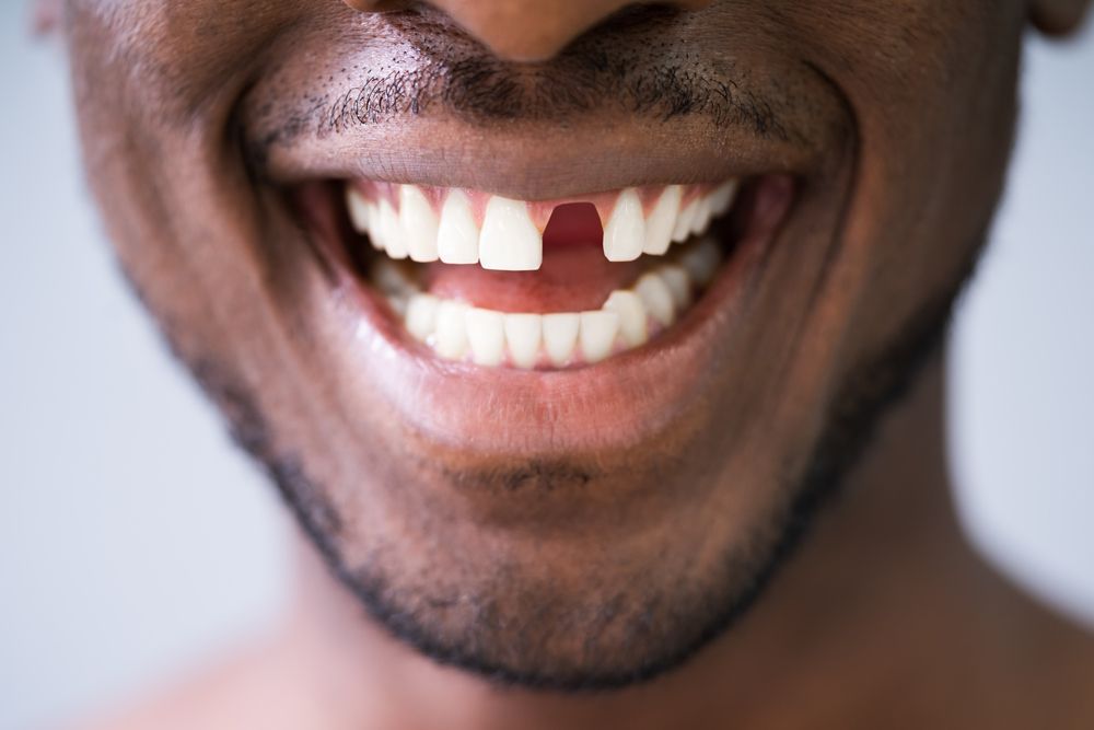 What Happens If You Don&rsquo;t Replace a Missing Tooth?