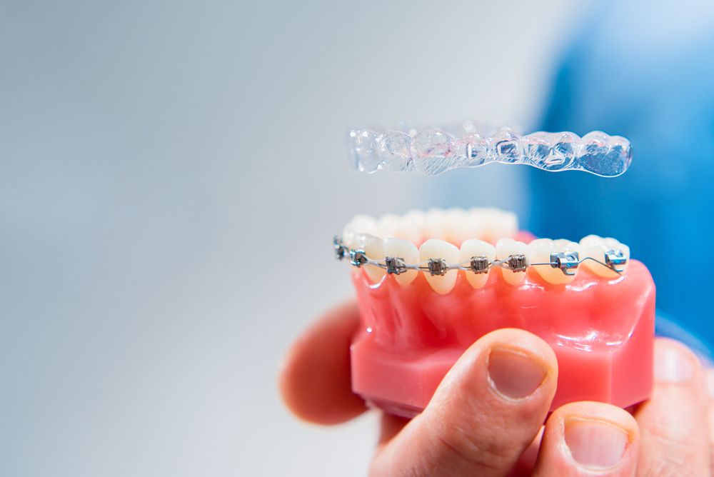 Invisalign vs. Traditional Braces: Which Option Fits Your Lifestyle?
