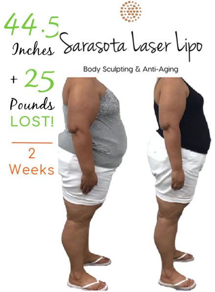 weight-loss-sarasota