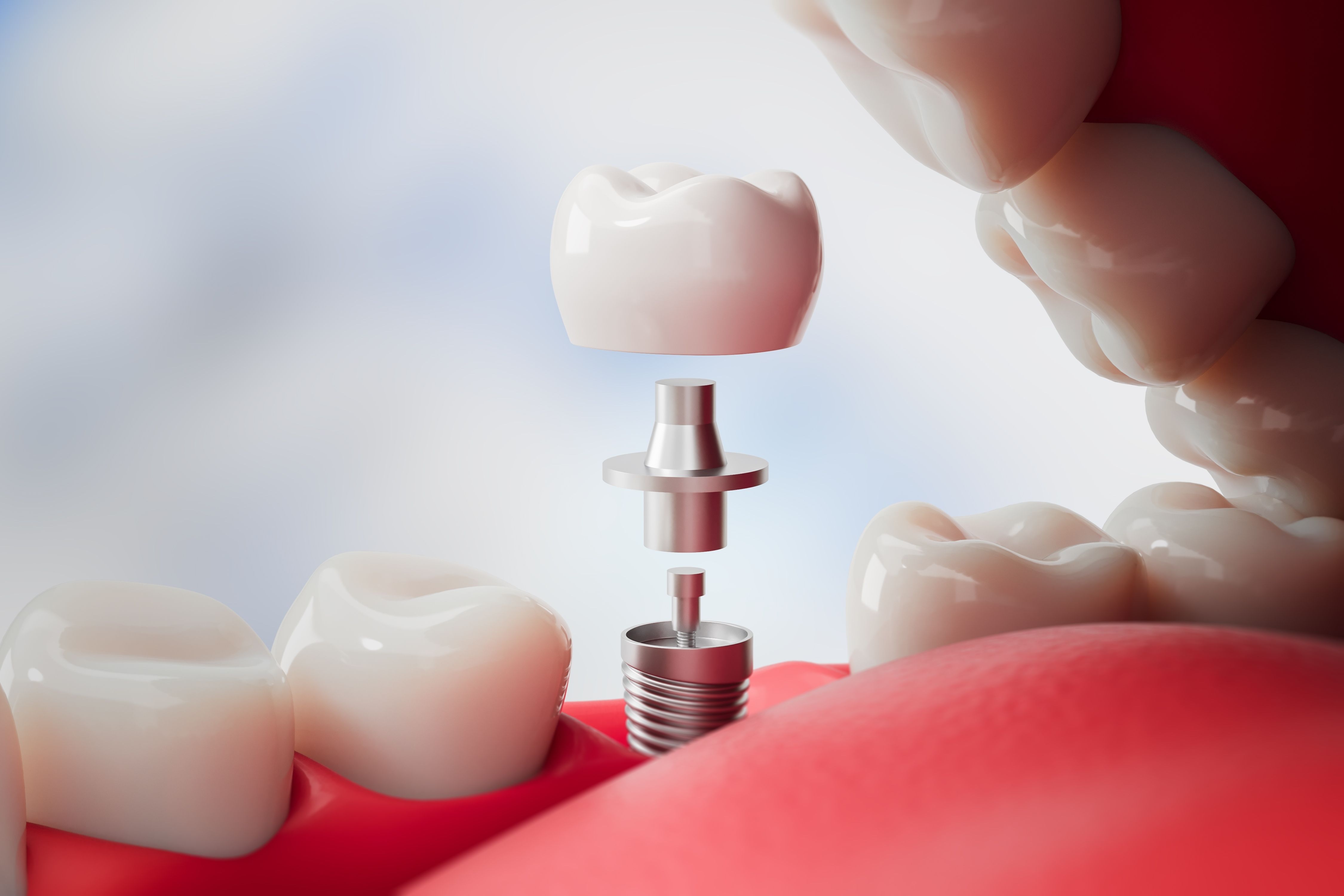 The Long-Term Benefits of Choosing Dental Implants