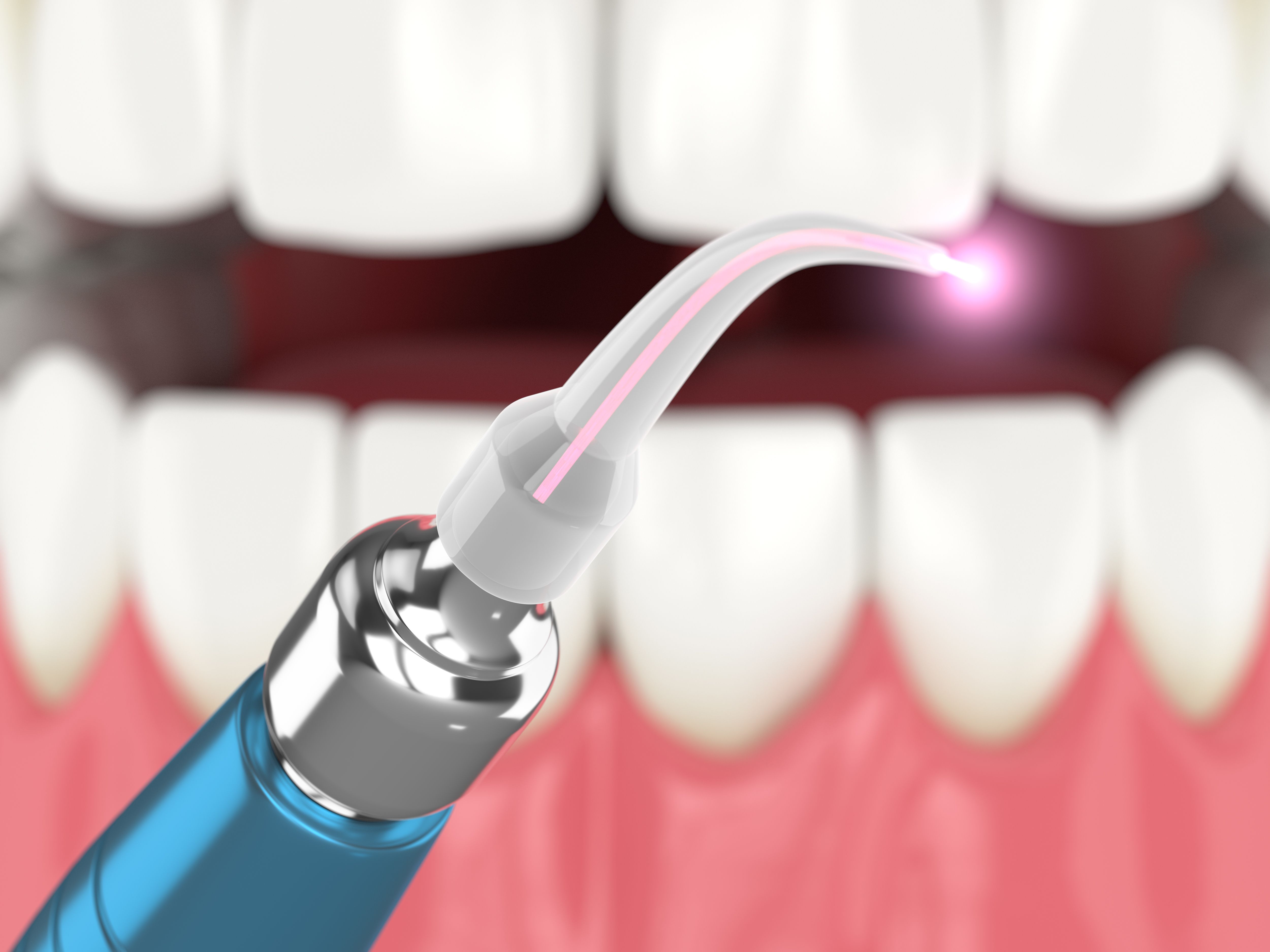 Experience Reduced Pain with Laser Dental Services
