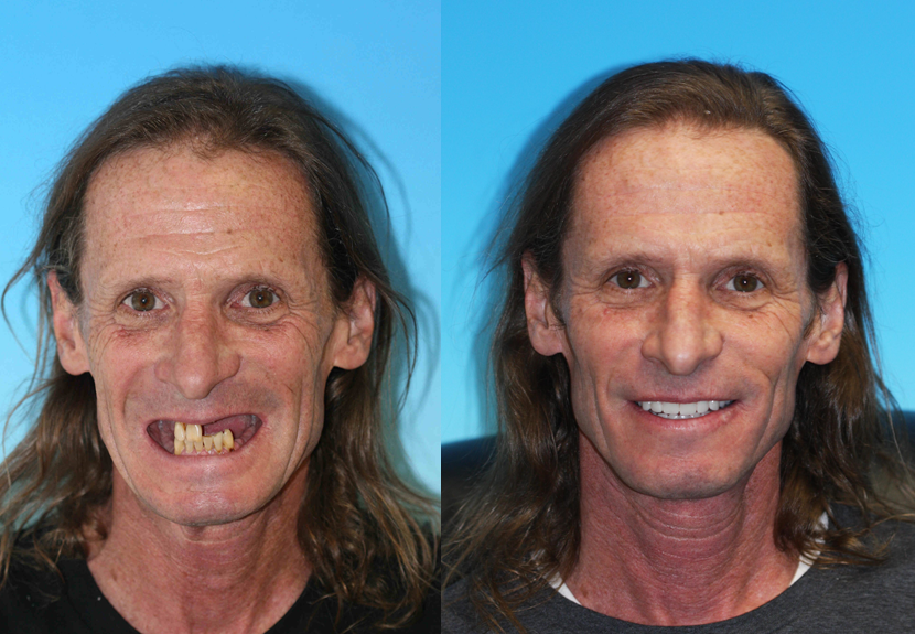 Cosmetic restoration dentist in denver