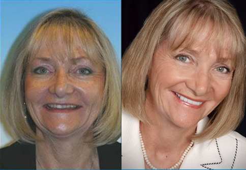 Cosmetic restoration dentist in denver