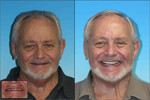 Cosmetic restoration dentist in denver