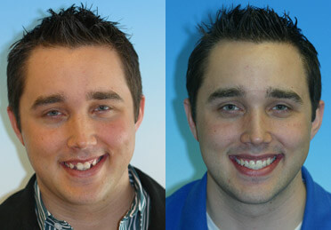 teeth straightening