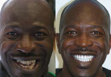 full dentures in denver