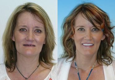 dentures in denver