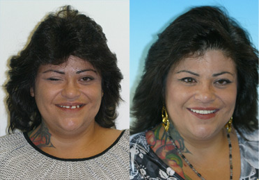 full mouth restoration dentist in denver