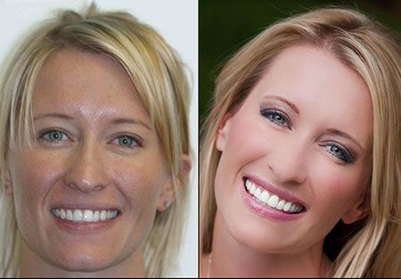 Super Fast Invisalign dentist in denver