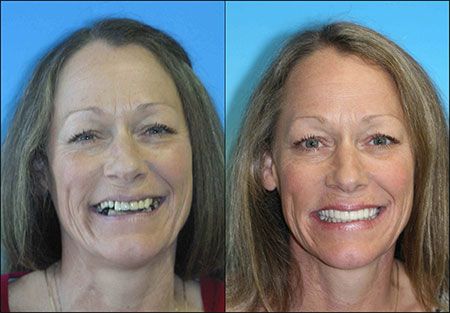 Cosmetic Restoration dentist in denver