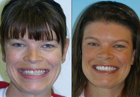 Veneers dentist in denver