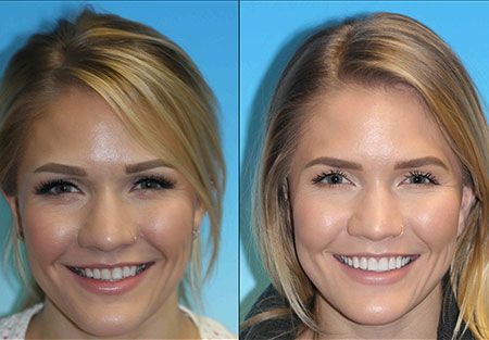 Veneers dentist in denver