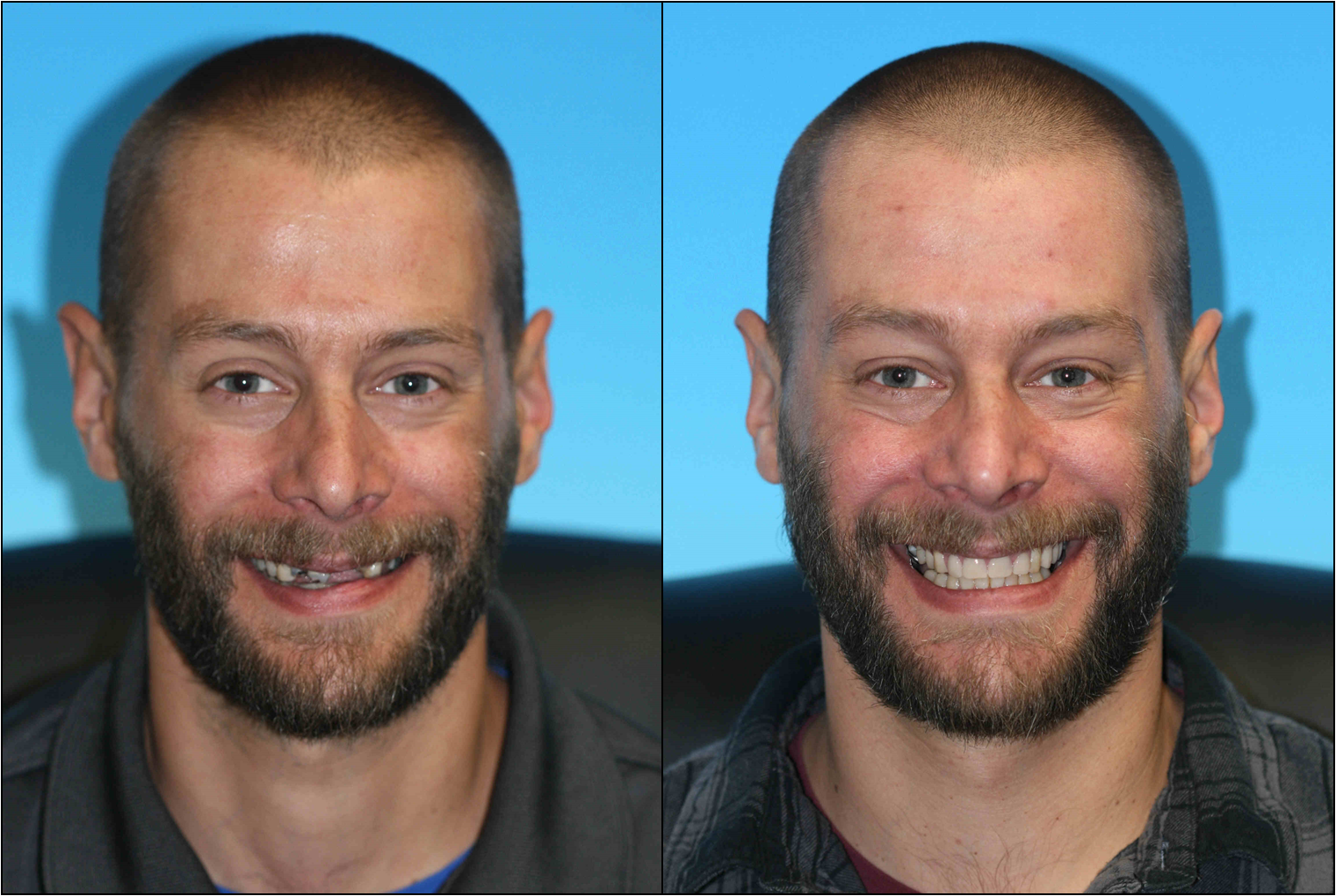 Cosmetic restoration dentist in denver