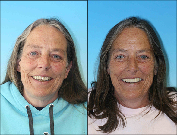 Cosmetic restoration dentist in denver
