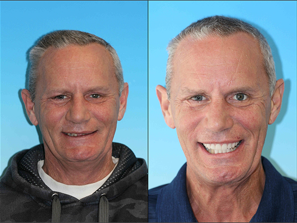 Cosmetic restoration dentist in denver