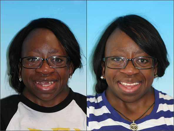 Cosmetic restoration dentist in denver